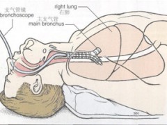北京呼吸专家姚宏胤解读：支气管扩张能不能治愈