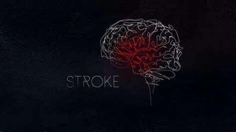 Stroke：住院的COVID-19患者卒中风险并不高！
