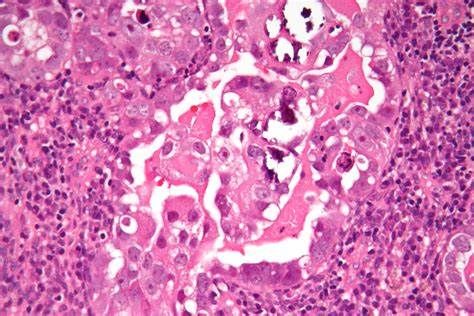 Clin #160;Cancer #160;Res：研究证实联合治疗侵袭性子宫内膜癌的有效性