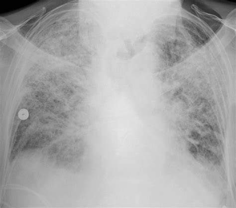 Leukemia：意外大发现！癌症药物治疗COVID-19急性呼吸窘迫患者！